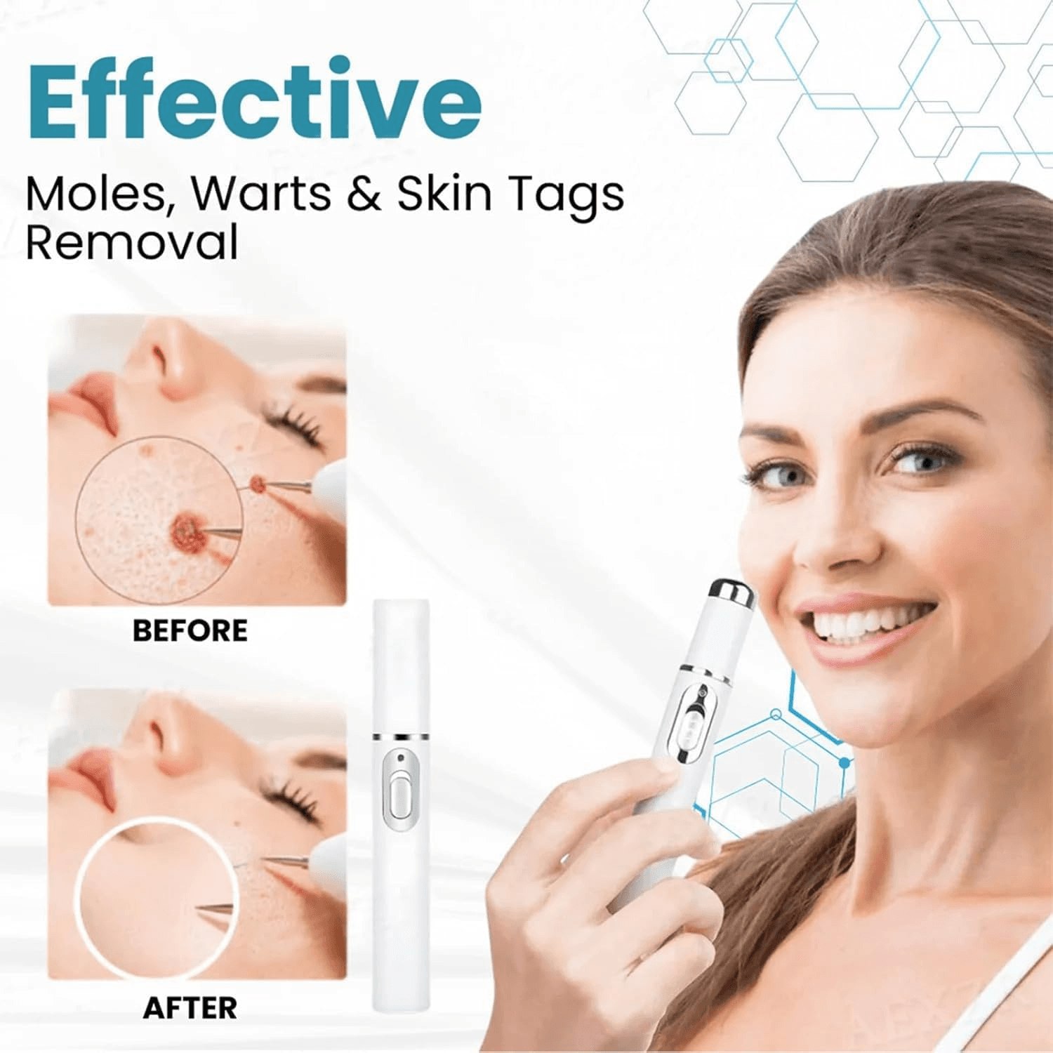 Mole & Wart Removal Laser Pen | Painless Skin Care – Dubai UAE