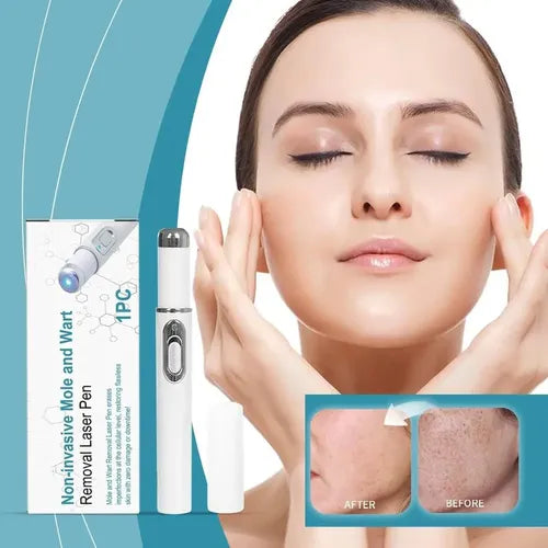 Mole & Wart Removal Laser Pen | Painless Skin Care – Dubai UAE