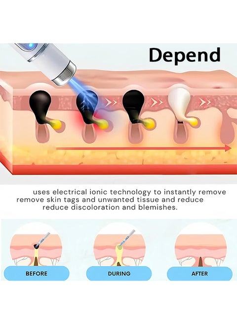 Mole & Wart Removal Laser Pen | Painless Skin Care – Dubai UAE